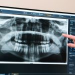 All-on-X Dental Implant Dentist in Kentwood MI